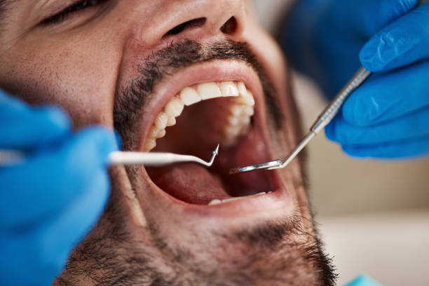 Best Emergency Dentist for Knocked-Out Tooth in Mukilteo, WA